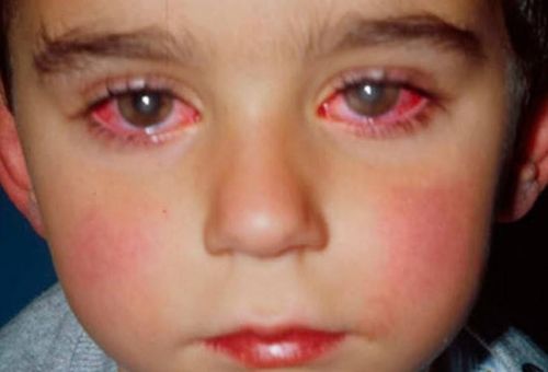 Đau mắt đỏ ở trẻ em và những điều cha mẹ cần biết