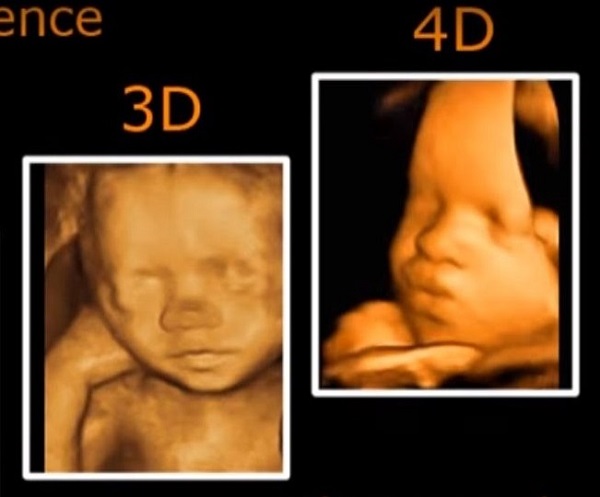 Sự khác nhau giữa siêu âm 2D, 3D và 4D trong siêu âm thai