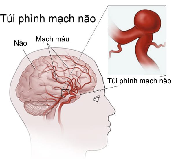 Bất chợt bị đau đầu dữ dội nên cảnh giác dị dạng mạch máu não