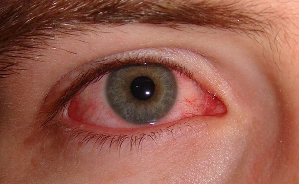 Bệnh đau mắt đỏ (viêm kết mạc) triệu chứng và cách phòng ngừa