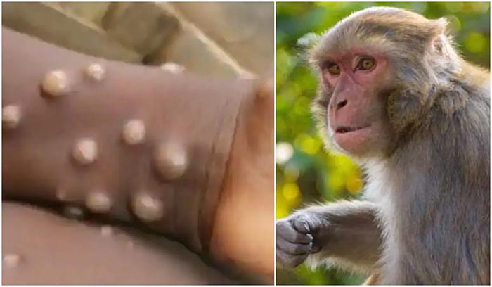Bệnh đậu mùa khỉ những điều bạn cần biết
