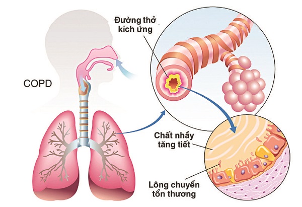 Đánh giá bệnh phổi tắc nghẽn mãn tính (COPD) bằng kết quả chụp X-quang