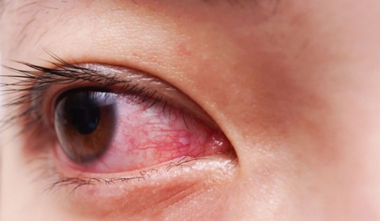 Đau mắt đỏ ở trẻ em có nguy hiểm: Nguyên nhân, dấu hiệu và cách chẩn đoán bệnh.
