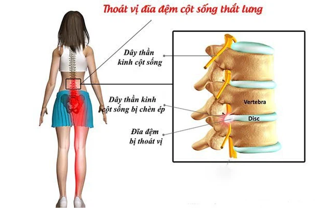 Điều trị thoát vị đĩa đệm cột sống thắt lưng bằng phương pháp vật lý trị liệu tại Chuyên khoa Y học cổ truyền – PKĐK Biển Việt