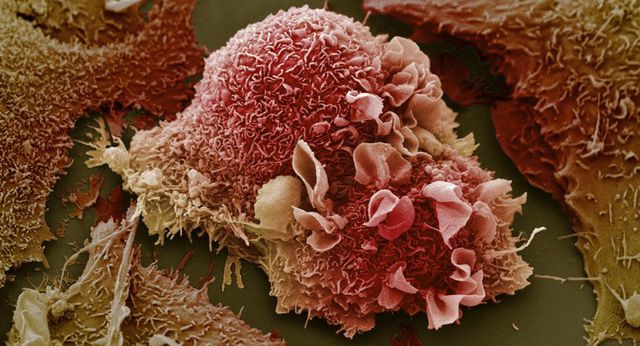 Khoa học phát hiện phương pháp điều trị ung thư mới