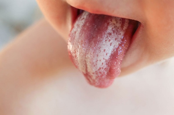 Nấm miệng ở trẻ em triệu chứng nhận biết và cách điều trị