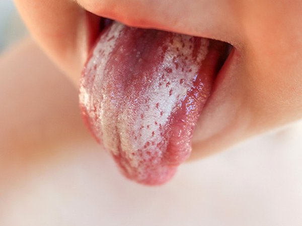 Tất tần tật những điều cần biết về bệnh nấm lưỡi ở trẻ em