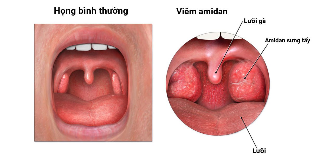 Viêm họng: Nguyên nhân, triệu chứng và cách phòng bệnh