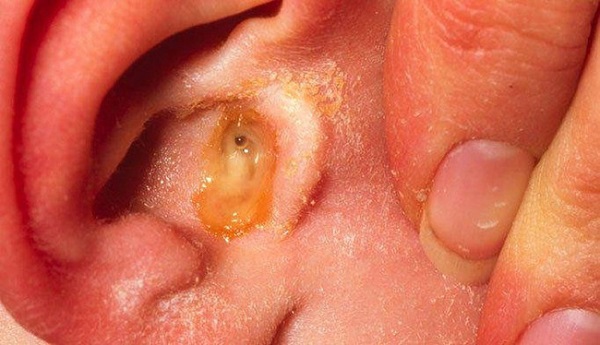 Viêm ống tai ngoài cách nhận biết và biện pháp phòng ngừa